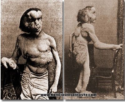 Joseph carey merrick-desformaciones-insolita