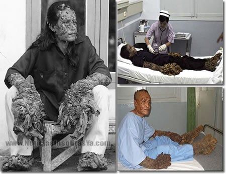 Dede-el-hombre-arbol-desformaciones-insolita