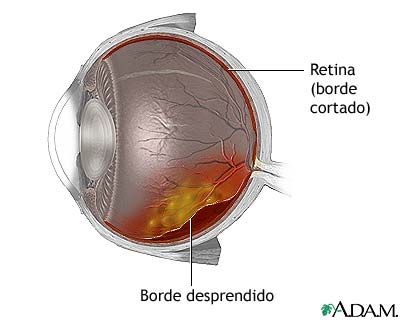 Ojo - desprendimiento retina