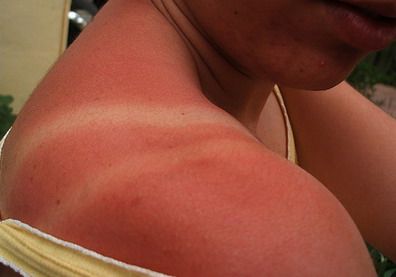 Quemaduras de sol - PORTADA