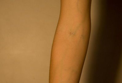 Lola pinchazos brazo P