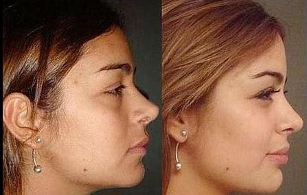 Larissa antes y despues3