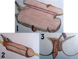 Reconstruccion-pene