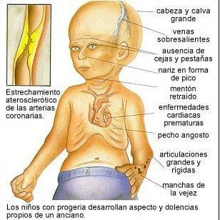 Gráfico envejecimiento prematuro interior