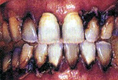 Dientes de un fumador P