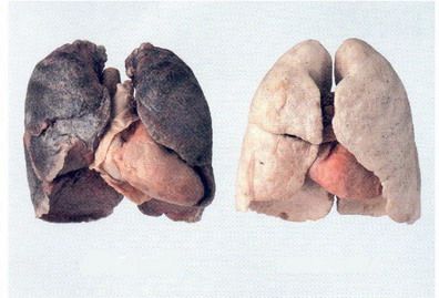 Pulmones de un fumador P