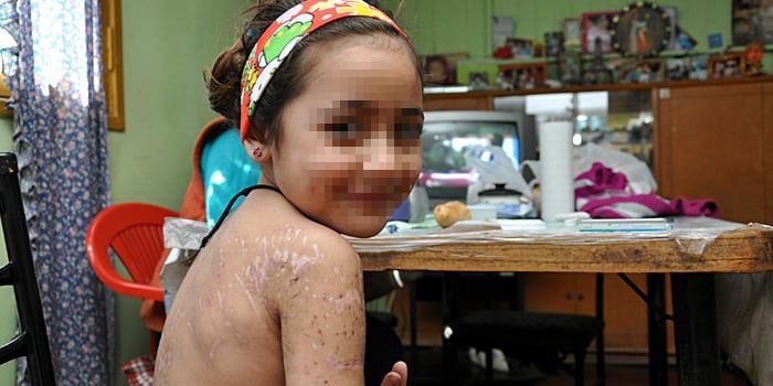 Luz de los Angeles, nena atacad por rottweiler