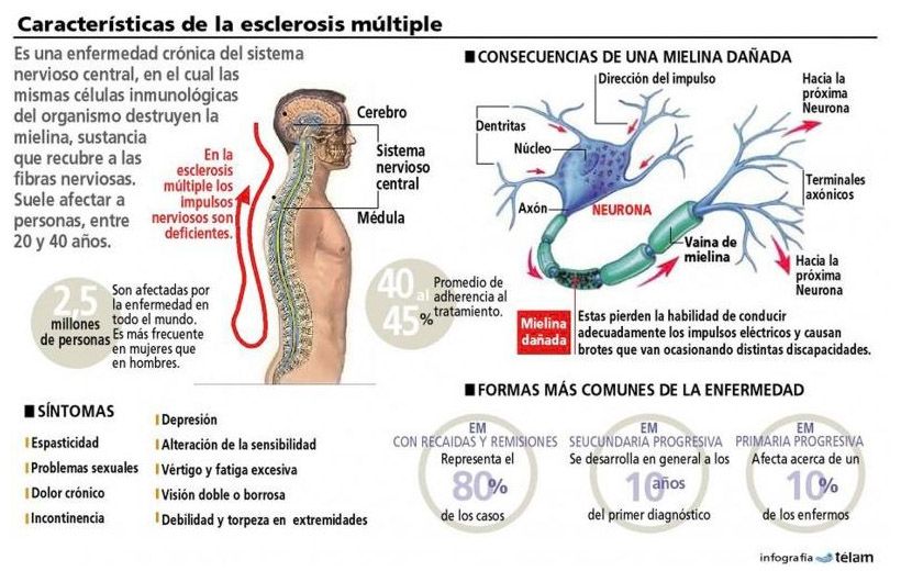 Esclerosis múltiple