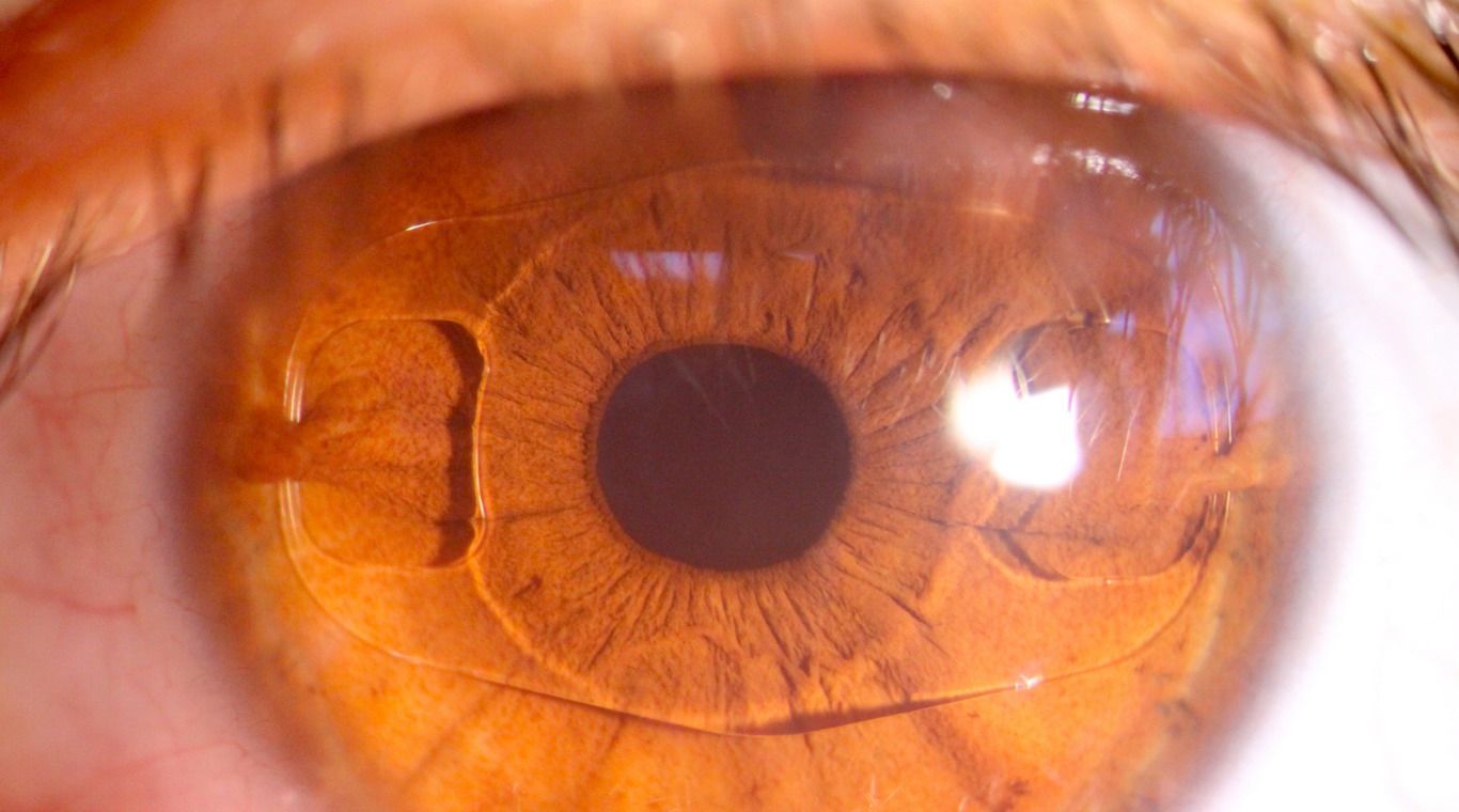 Lentes intraoculares New