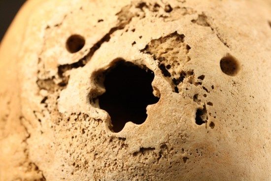 Trepanación craneal Perú 2