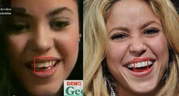 Shakira dientes