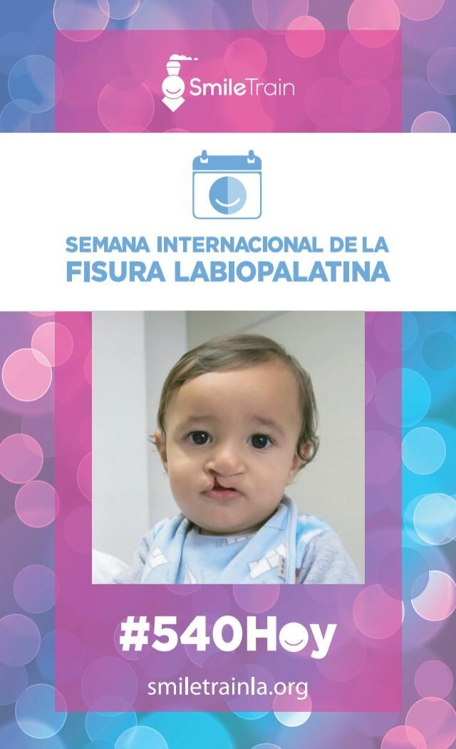 fisura labio palatina