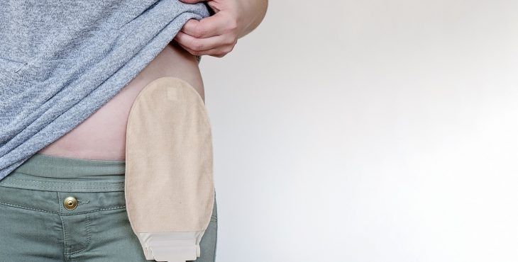 ostomizado