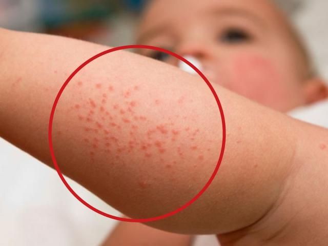 dermatitis atópica