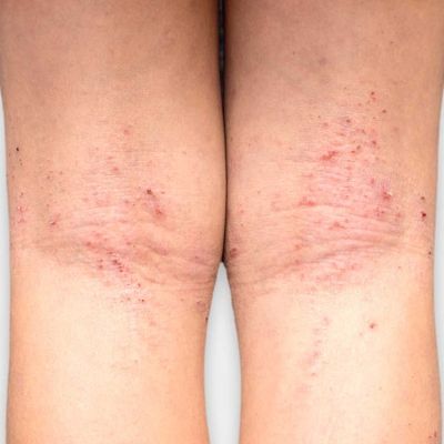 dermatitis atópica