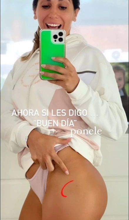 Cinthia Fernández mostrando las picaduras de pulgas.