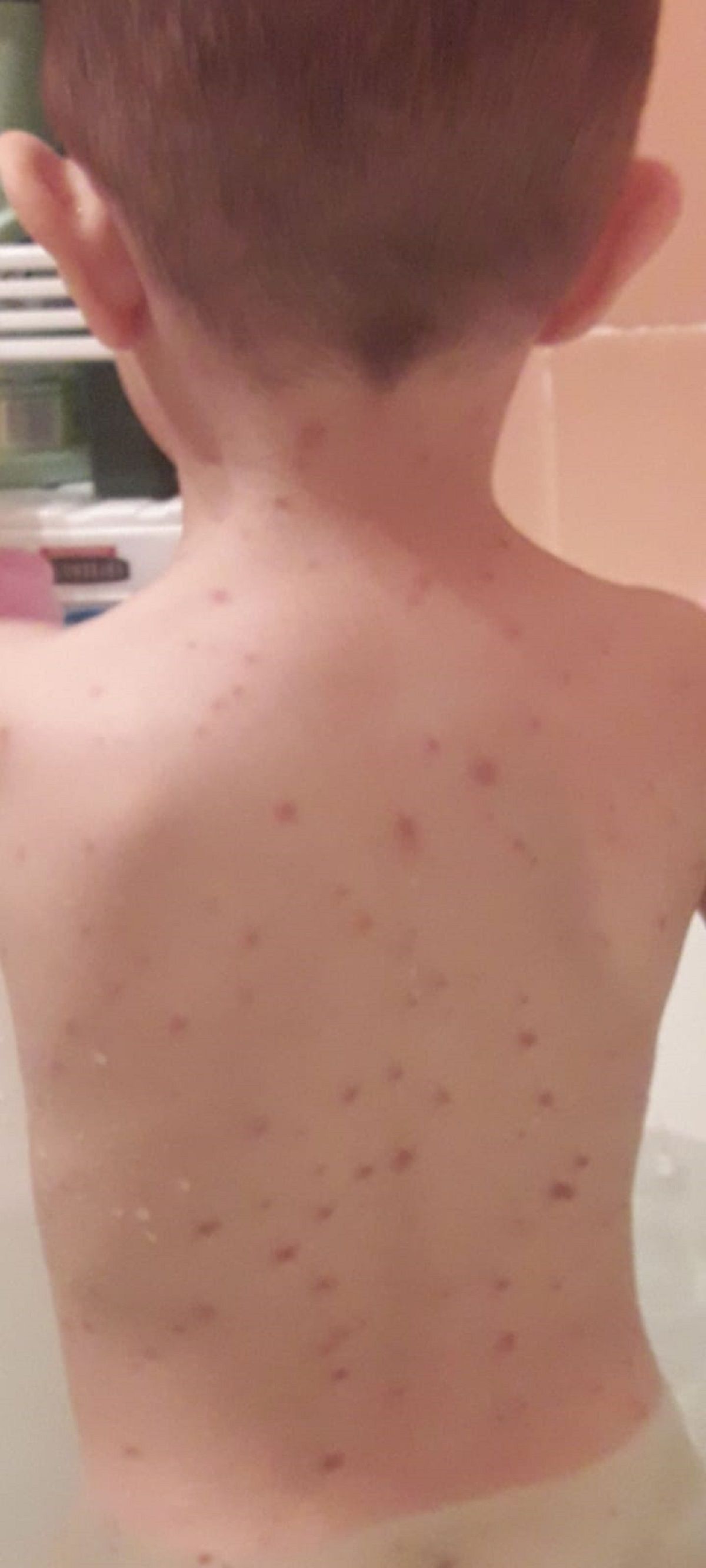 Las manchas amarronadas en el cuerpo son una señal