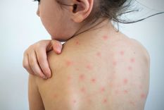 El número estimado de casos de sarampión asciende a 9 millonesFoto: NIH MedlinePlus. Foto: NIH MedlinePlus El número estimado de casos de sarampión asciende a 9 millonesFoto: NIH MedlinePlus. Foto: NIH MedlinePlus