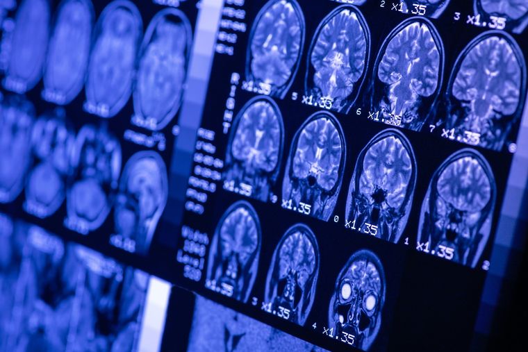El estudio utilizó ChatGPT para decodificar las ideas de los sujetos de prueba Foto: Shutterstock