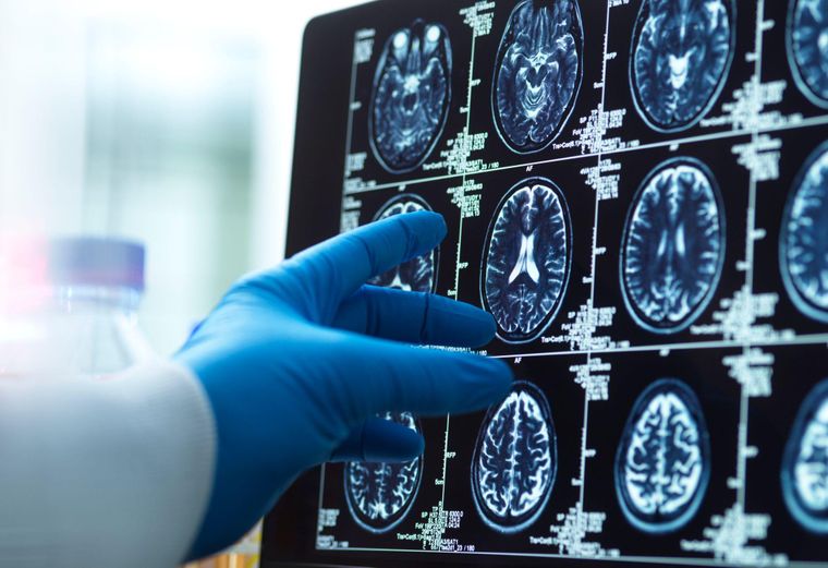 Los traumatismos en la cabeza pueden generar alteraciones cerebrales.