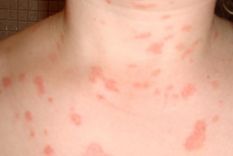 el 80% de personas con psoriasis mejoran al exponerse al sol el 80% de personas con psoriasis mejoran al exponerse al sol
