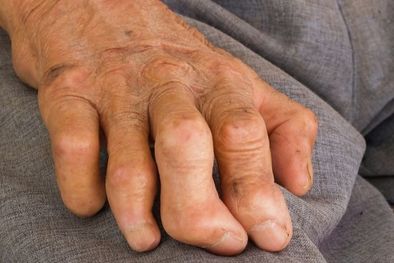 MDZol | La lepra puede dañar los nervios y provocar discapacidad Foto: GETTY IMAGES