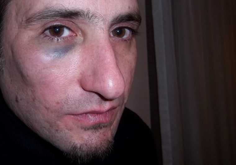 Maxi Amué pretende demostrar con esta foto que sí fue golpeado.