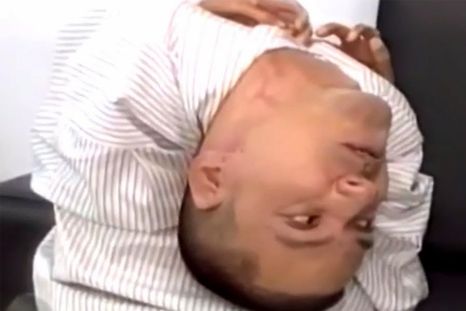 La rara condición del hombre que nació con la cabeza al revés