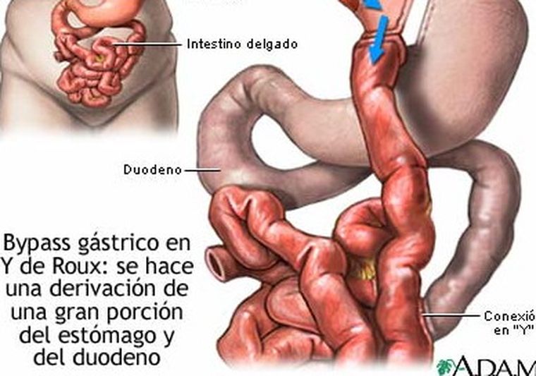 Explicación sobre el procedimiento de by pass gástrico. Foto: web
