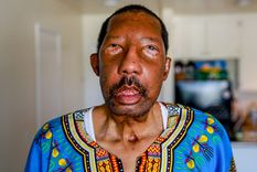 Mi nueva vida con la cara de un extraño: la conmovedora historia del primer afroestadounidense en recibir un trasplante de rostro completo