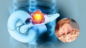 El adenocarcinoma ductal de páncreas -el tipo más habitual de cáncer de páncreas y el de peor pronóstico- suele diagnosticarse demasiado tarde.