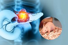 El adenocarcinoma ductal de páncreas -el tipo más habitual de cáncer de páncreas y el de peor pronóstico- suele diagnosticarse demasiado tarde.