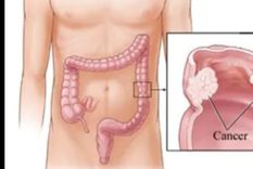 Con 13.500 casos detectados al año y 20 muertes por día, el cáncer colorrectal es el segundo cáncer en frecuencia y en cantidad de muertes en nuestro país. Foto: Gentileza SACP