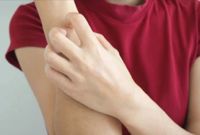 Entre los síntomas puede aparecer la picazón e hinchazón de distintas partes del cuerpo. Foto: Shutterstock