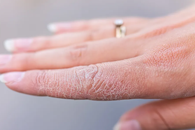 MDZol | El problema clave es que tratamos la sequedad de las manos con productos que no son los adecuados. Foto: laopinion.com https://laopinion.com/wp-content/uploads/sites/3/2021/11/shutterstock_1548276371.jpg?quality=80&strip=all&w=1200