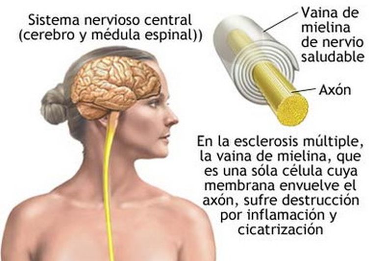 Según los especialistas, la probabilidad de incapacidad aumenta con el tiempo que alguien sufre este complicado mal.