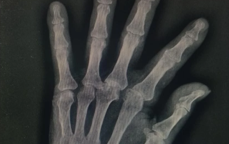 Hernán presentó una fractura en el pulgar. Hernán presentó una fractura en el pulgar.