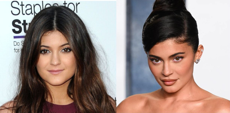 Kylie Jenner habla de los retoques estéticos de su rostro Kylie Jenner antes y después de los fillers. Foto: MDZ ONLINE