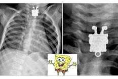 un bebe se trago un collar de bob esponja