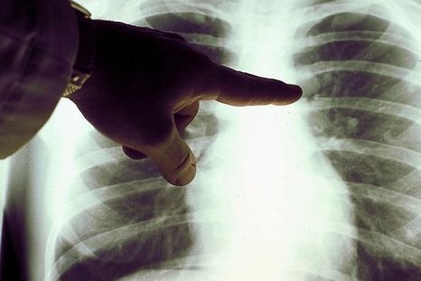 Sin medicación específica adicional, el linfoma de un paciente que contrajo el coronavirus desapareció, según una investigación. Foto: GETTY IMAGES