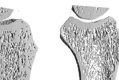 plasma rico en plaquetas para el tratamiento de la artrosis de cadera