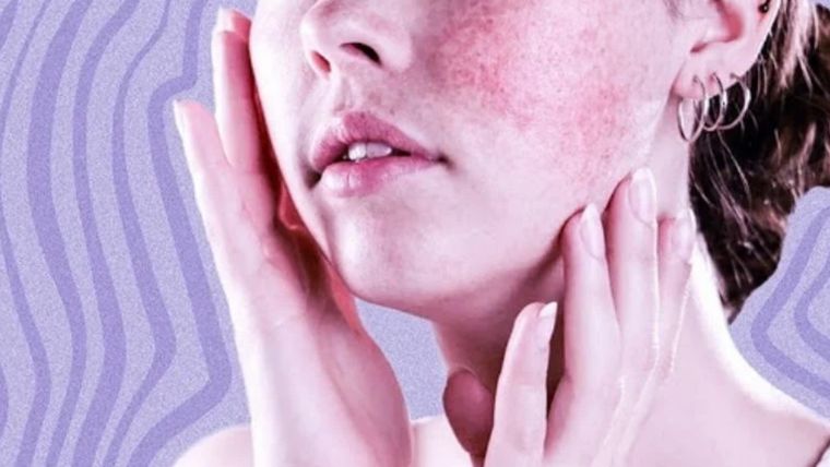 Se estima que al menos 5 millones de personas en todo el mundo tienen lupus. Foto: MDZ