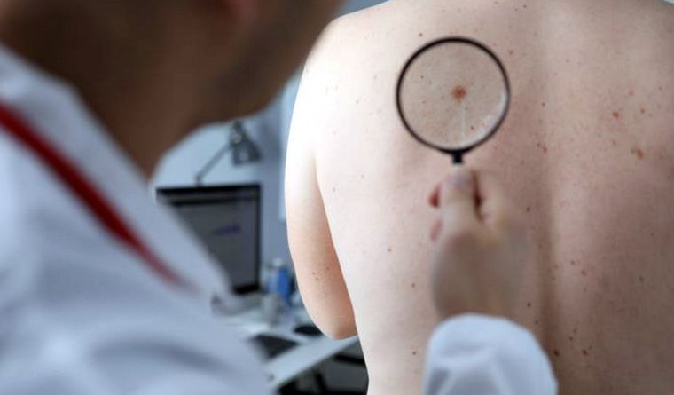 Un estudio español se enfoca en el cáncer de piel. Foto Efe