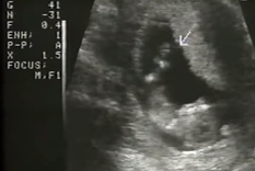 el precio del aborto, en una infografia