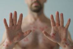 La viruela del mono provoca lesiones en el cuerpo