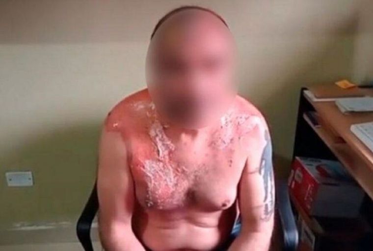 El hombre sufrió quemaduras de primer grado