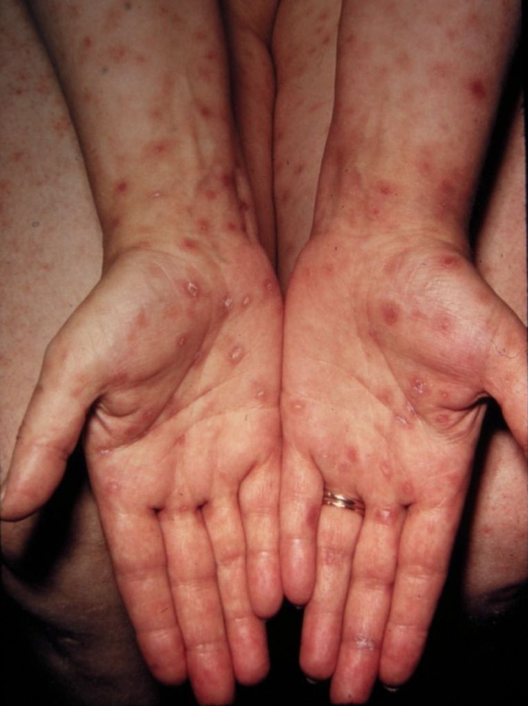 En Argentina se detectaron 55.183 nuevos casos de sífilis en 2025. En Argentina se detectaron 55.183 nuevos casos de sífilis en 2025.