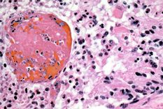 Así se observa un glioblastoma. Foto: Colegio de Patólogos Americanos / Sputnik