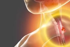 cuales son los sintomas del cancer de esofago y por que no debemos ignorarlos