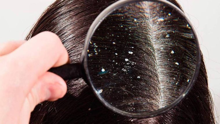 CASPA Esta afección es conocida científicamente como dermatitis seborréica Foto: SHUTTERSTOCK